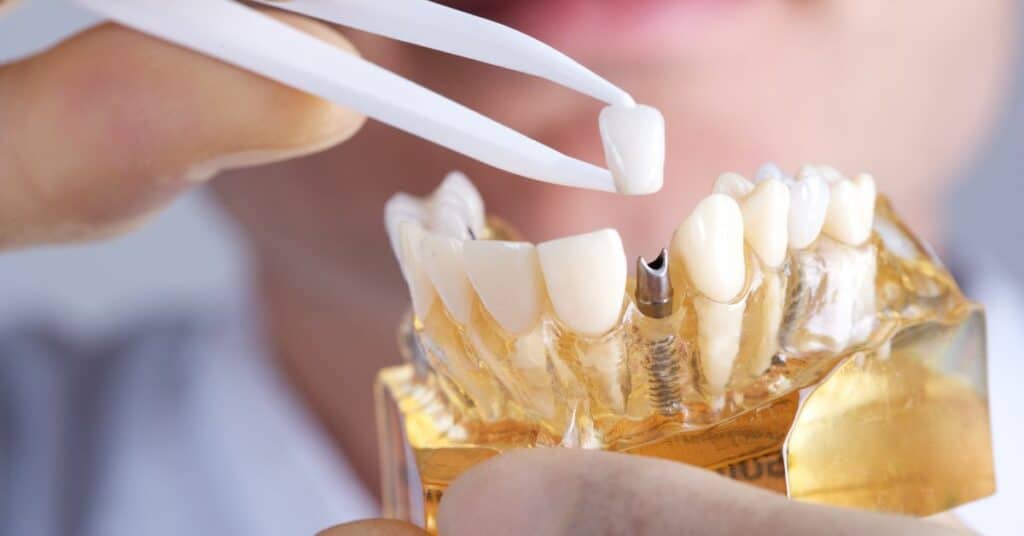 הבנת הצורך בהשתלות שיניים